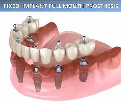 IMPLANT denture