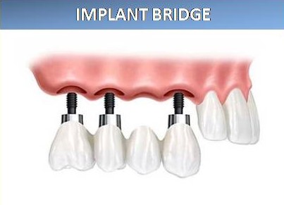 IMPLANT BRIDGE