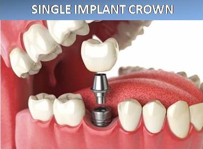 IMPLANT CROWN