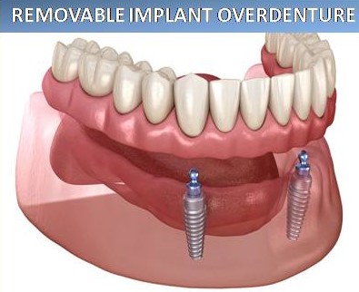 overdenture