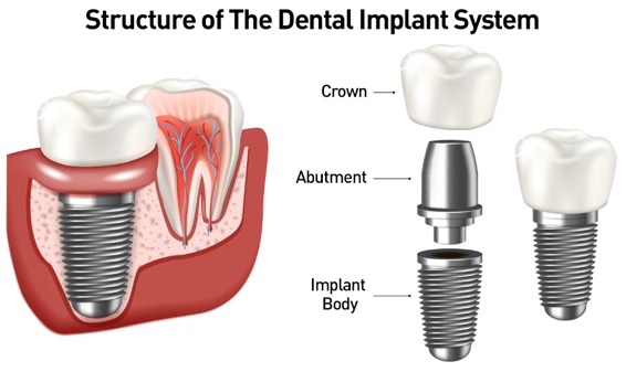 implants