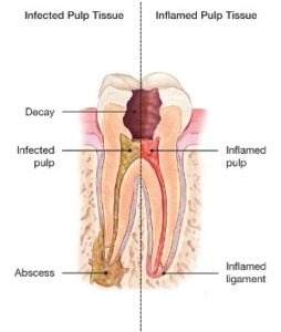 infected pulp